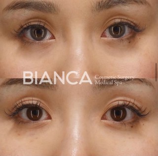 スネコス💉ダウンタイムはどのくらい？