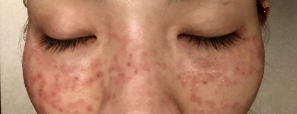 シミ撃退👊💓～ピコスポット～