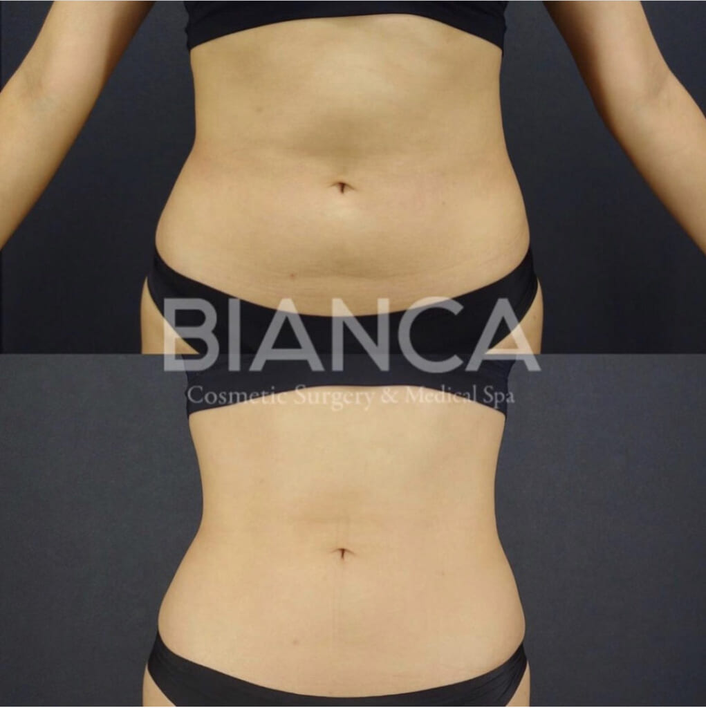 エムスカルプトでボディメイク🏋️‍♂️