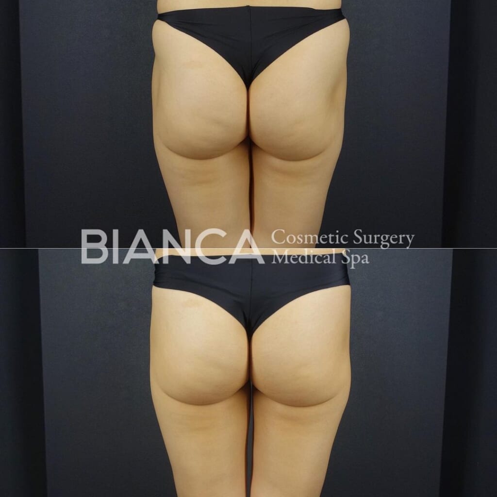 大人気のエムスカルプト💪✨