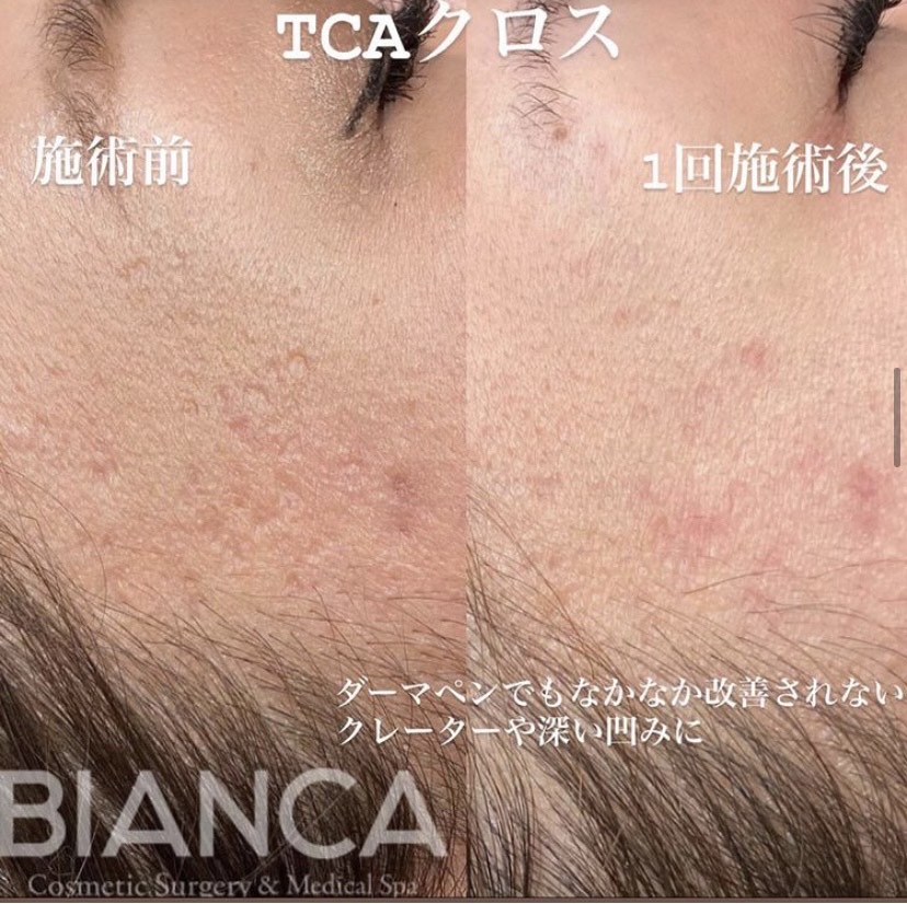 TCAクロスって何？✨