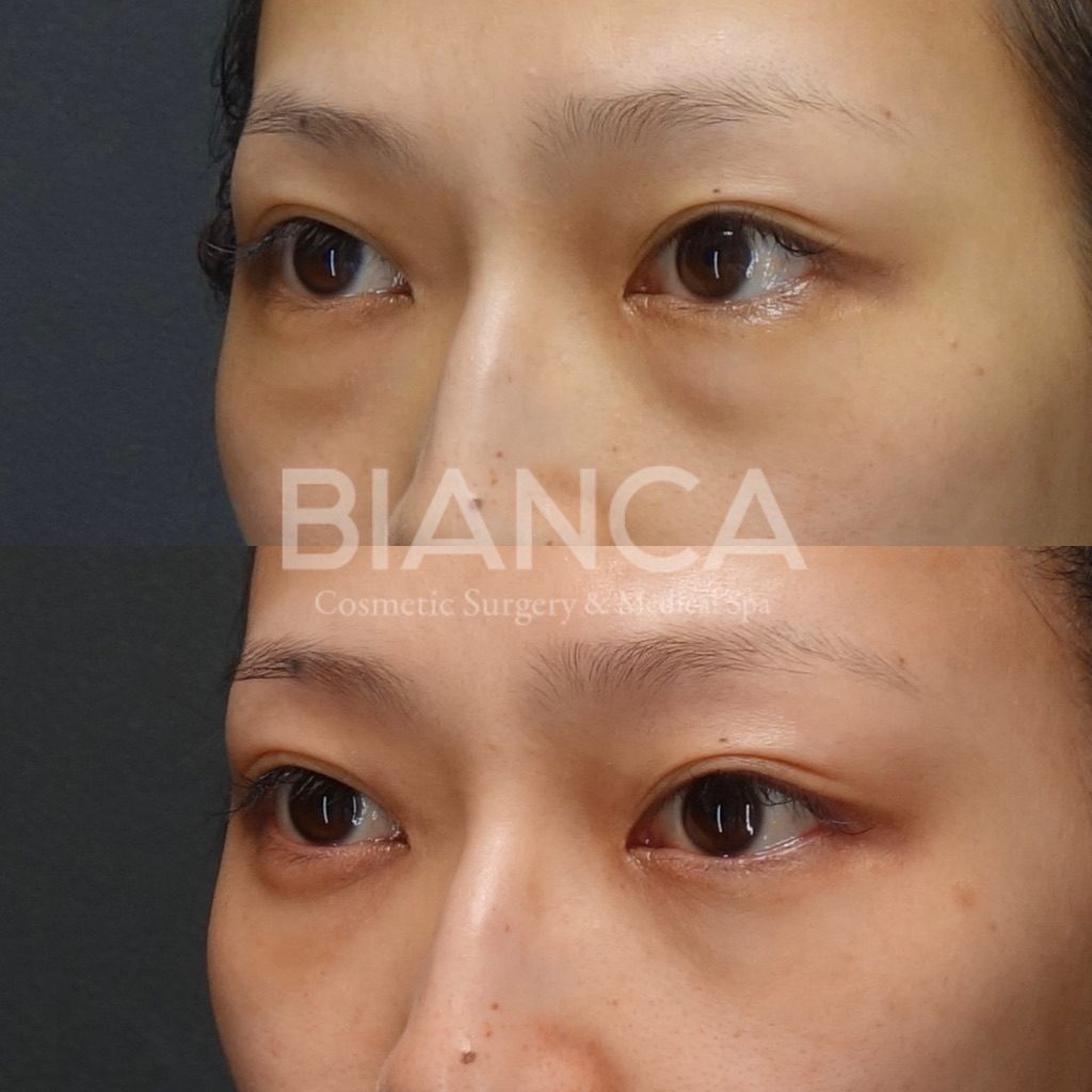 クマ取り（経結膜脱脂術）の経過は？腫れ・内出血・仕上がりを医師が解説【ビアンカクリニック】