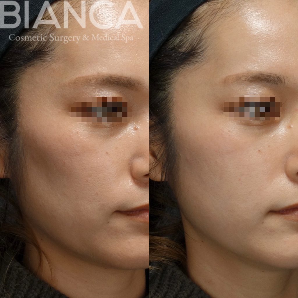 頬コケ改善にヒアルロン酸は有効？自然なふっくら感を取り戻す注入治療とは