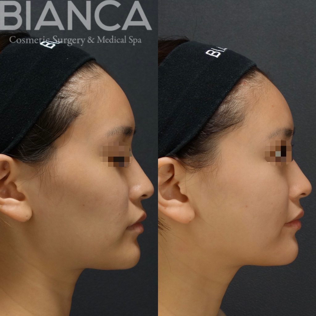 コメカミ×頬こけ ヒアルロン酸