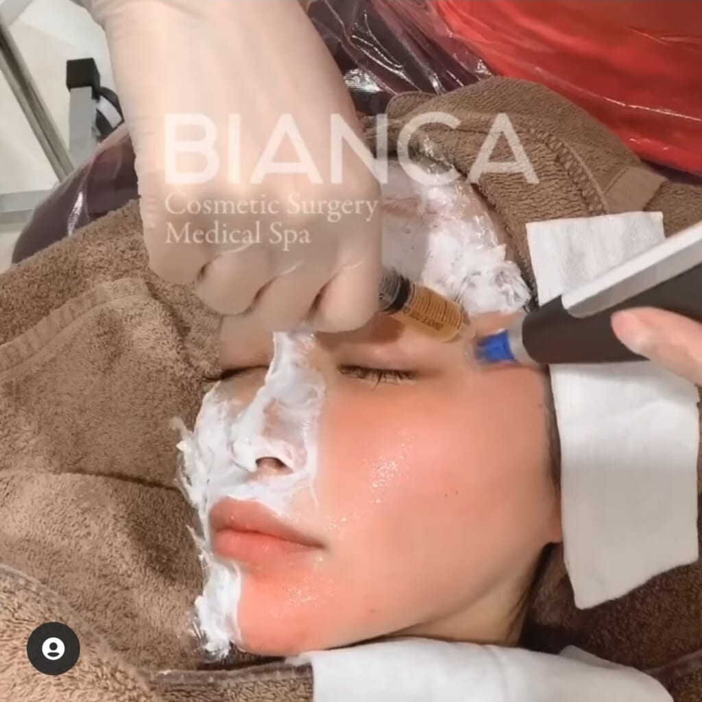 ヴァンパイアフェイシャルって何？✨