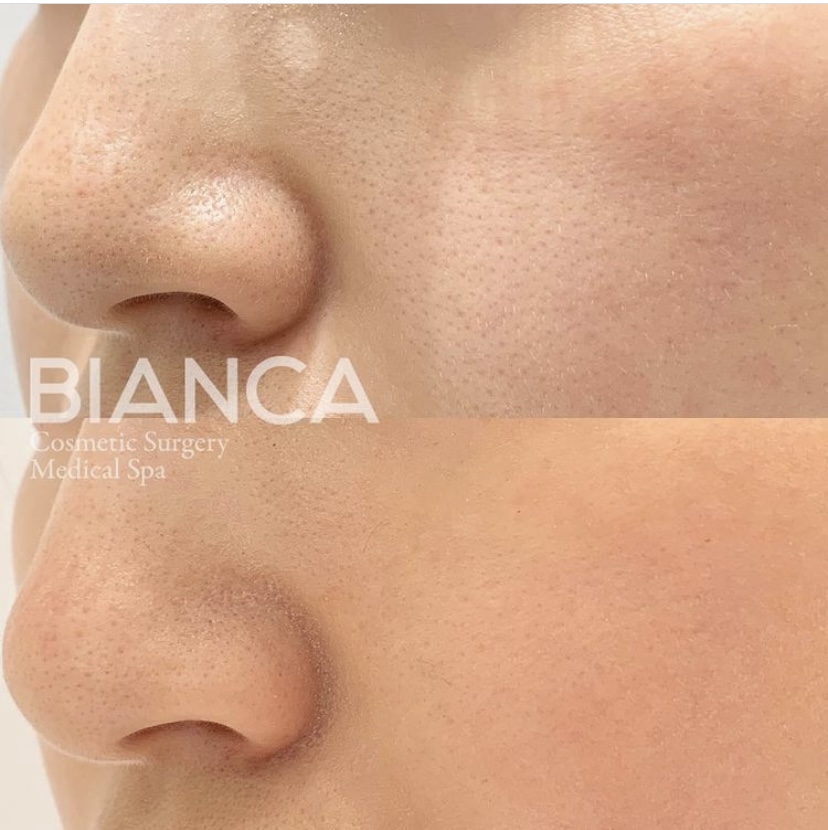 ヴァンパイアフェイシャル🧛‍♀️✨体験談