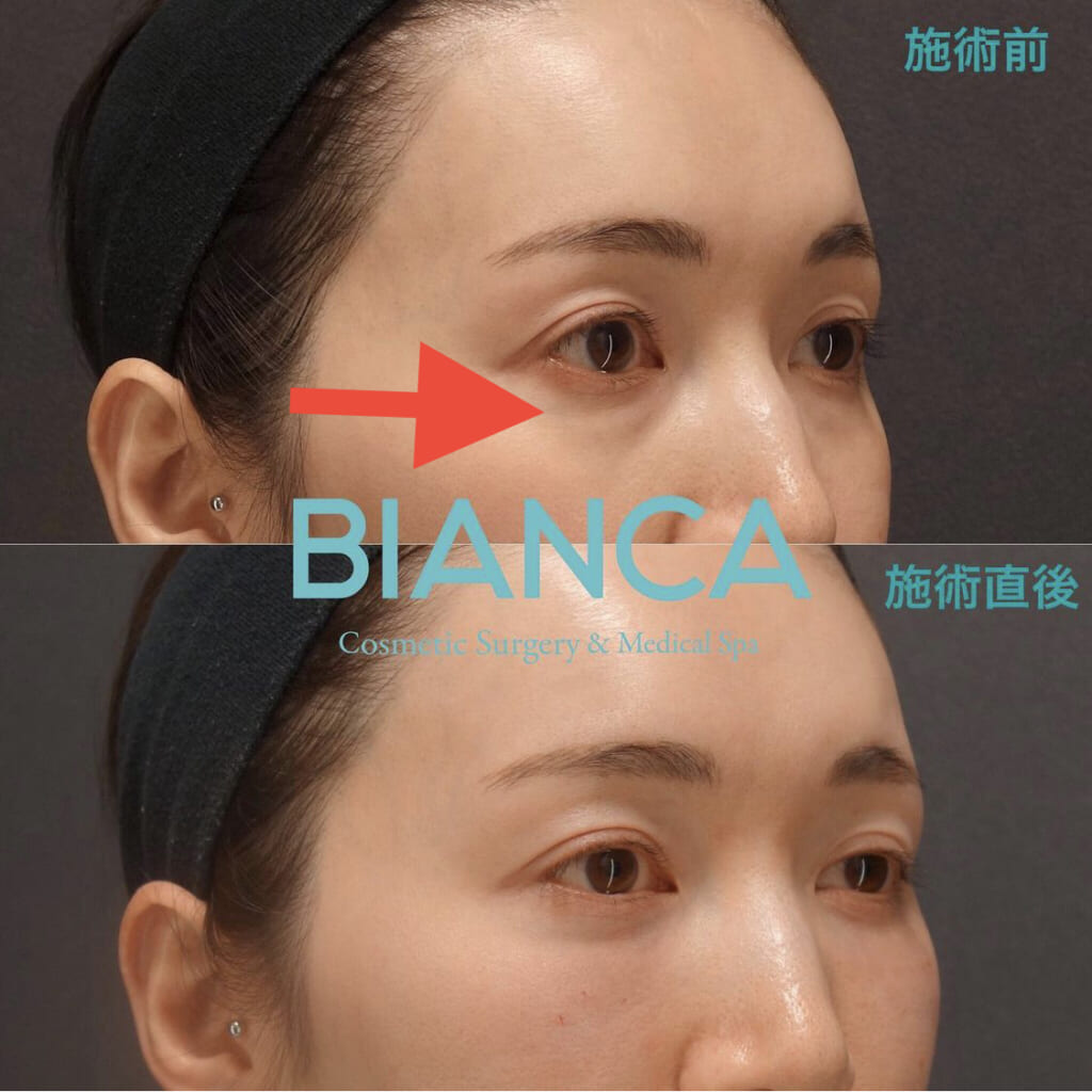 OPE体験談✨目の下のクマたるみ取り🧸