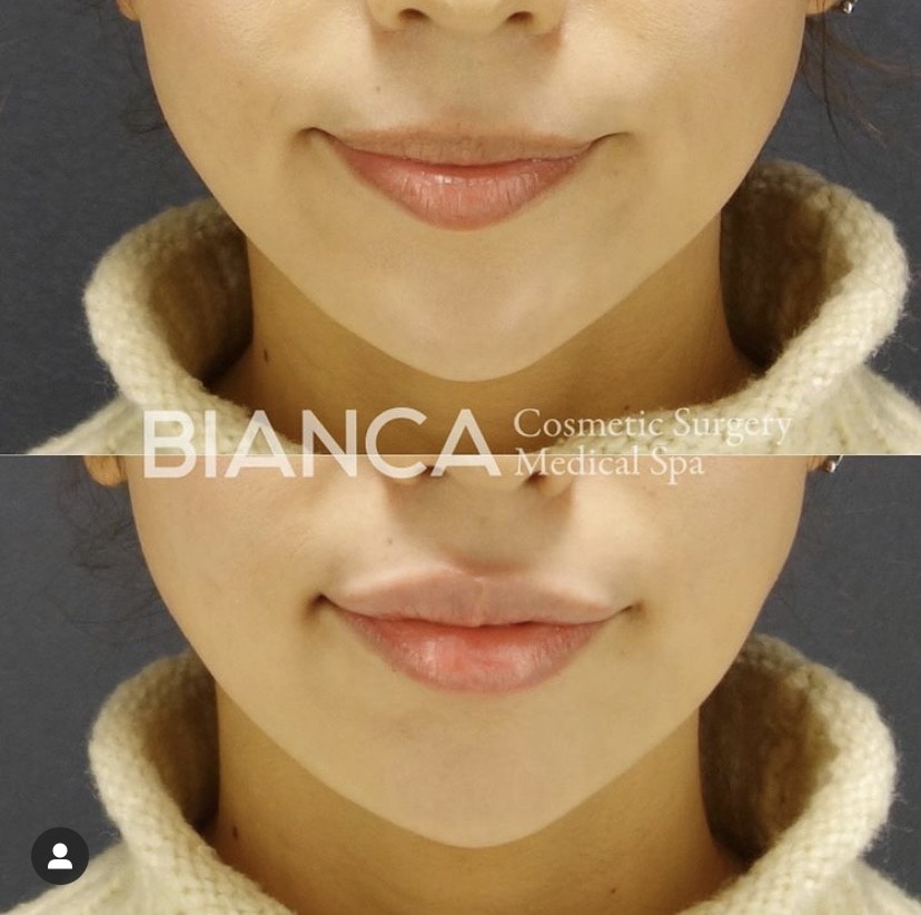 唇ヒアルロン酸について💉💄💖