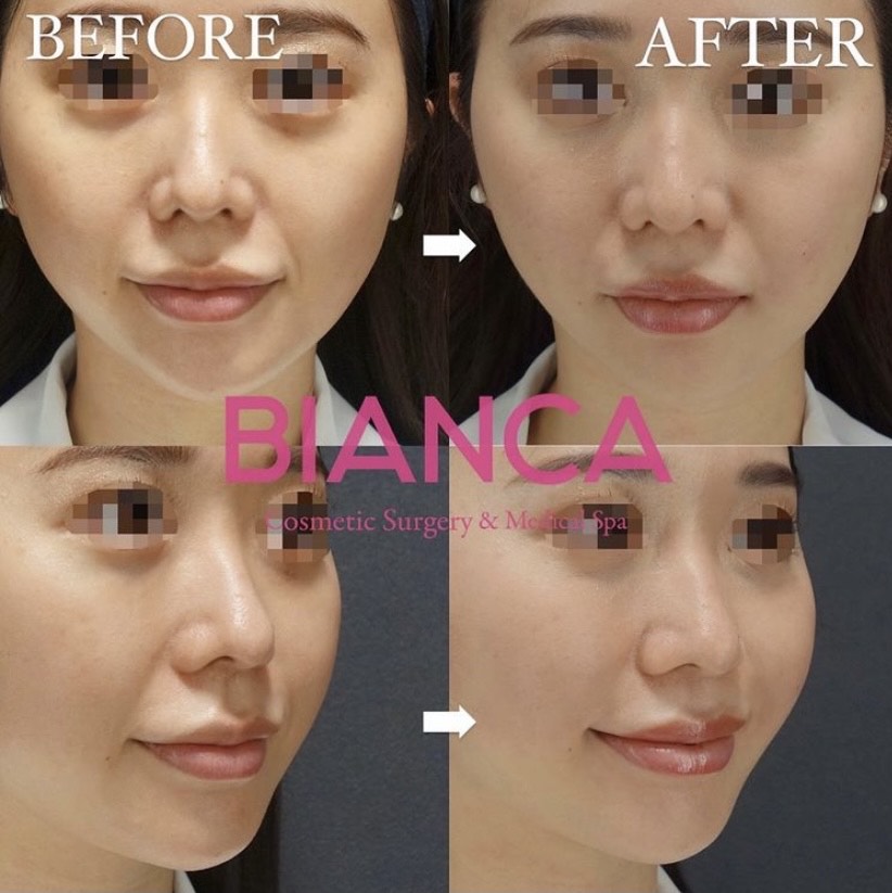 大人気！法令線ヒアルロン酸💉💗