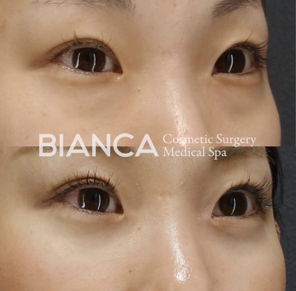 目の下のクマ・たるみ取り