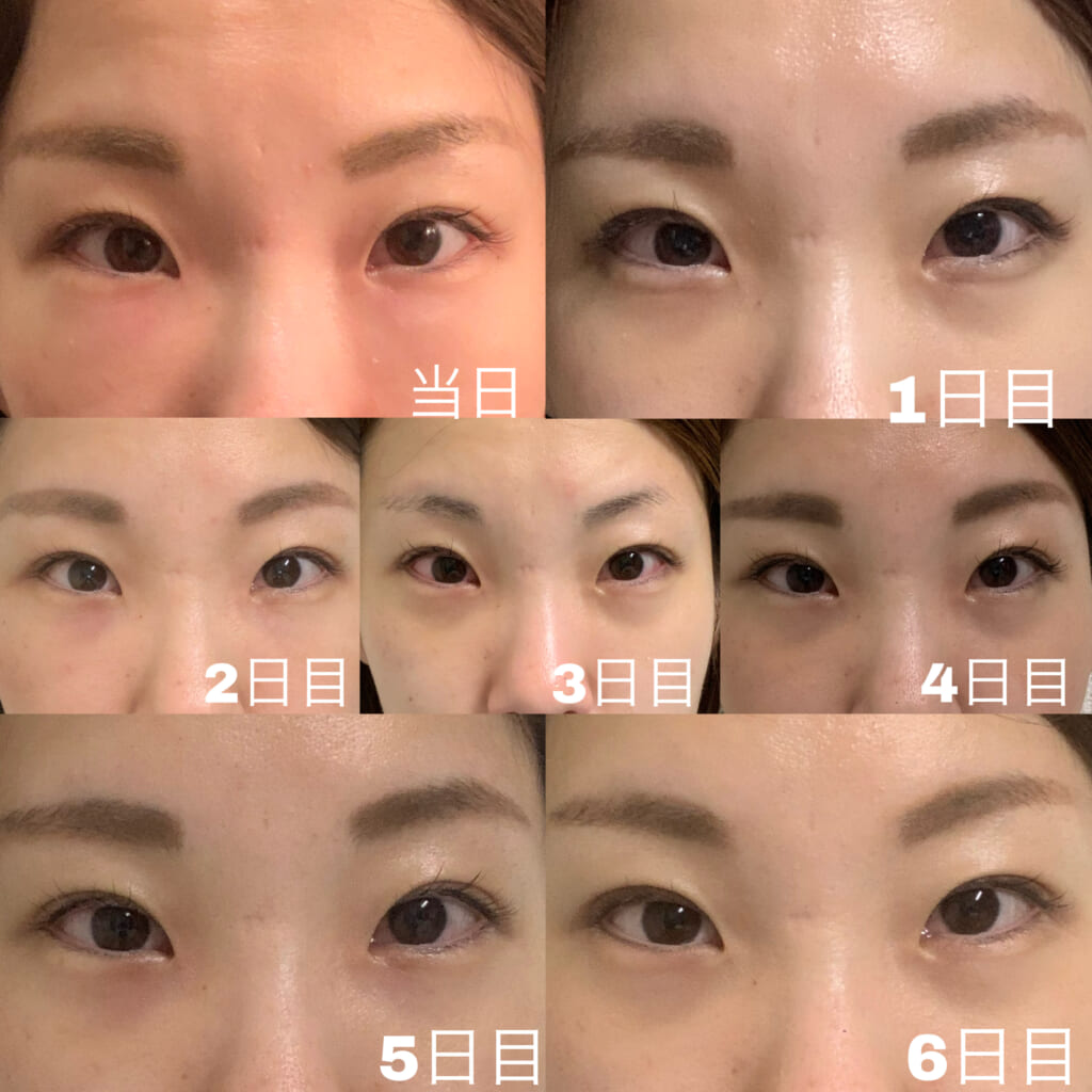 目の下のクマ・たるみ取りダウンタイム