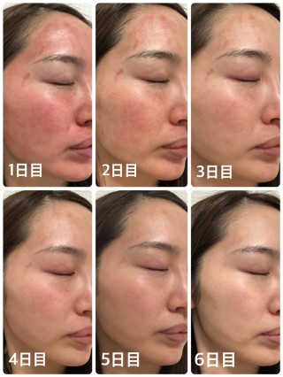 ヴァンパイアフェイシャル体験談💉💕