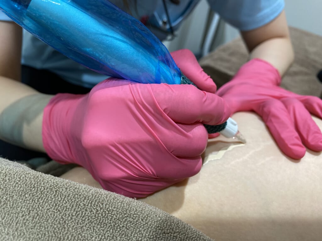 スカーレス🖊症例写真📸°˖✧