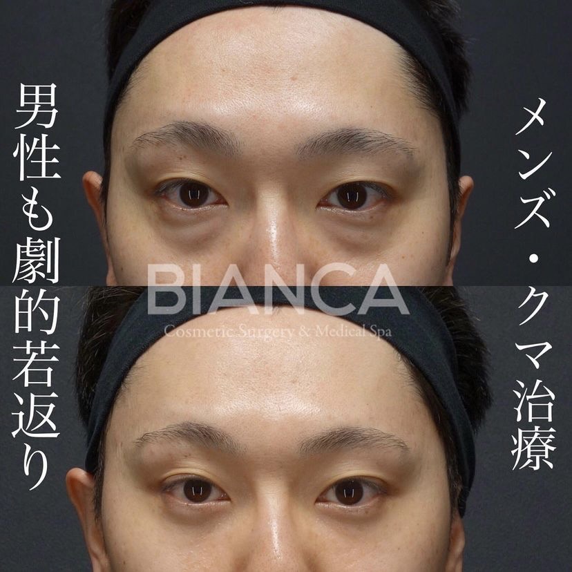 メンズ必見！メンズクマ取りキャンペーン始まります💗