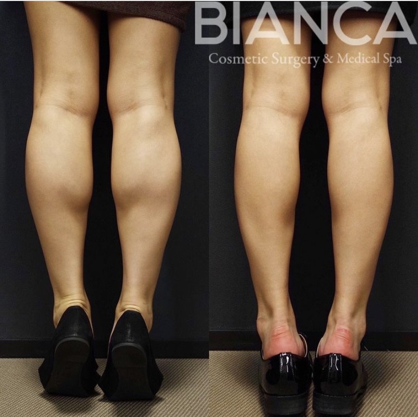 美脚💗ふくらはぎボトックス👠✨