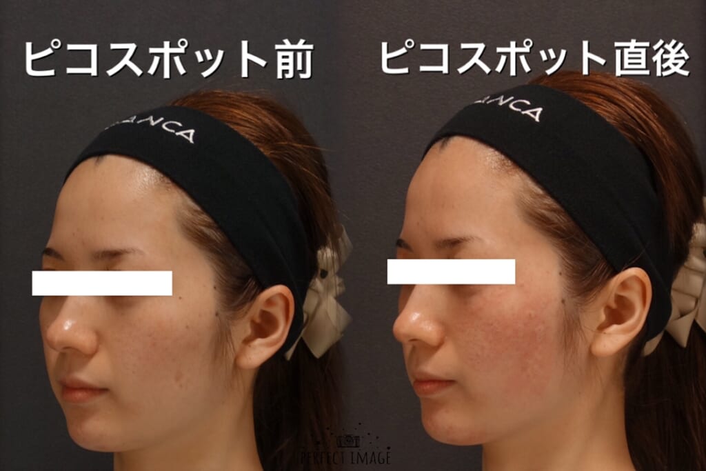 しみ撃退にはピコスポット💯