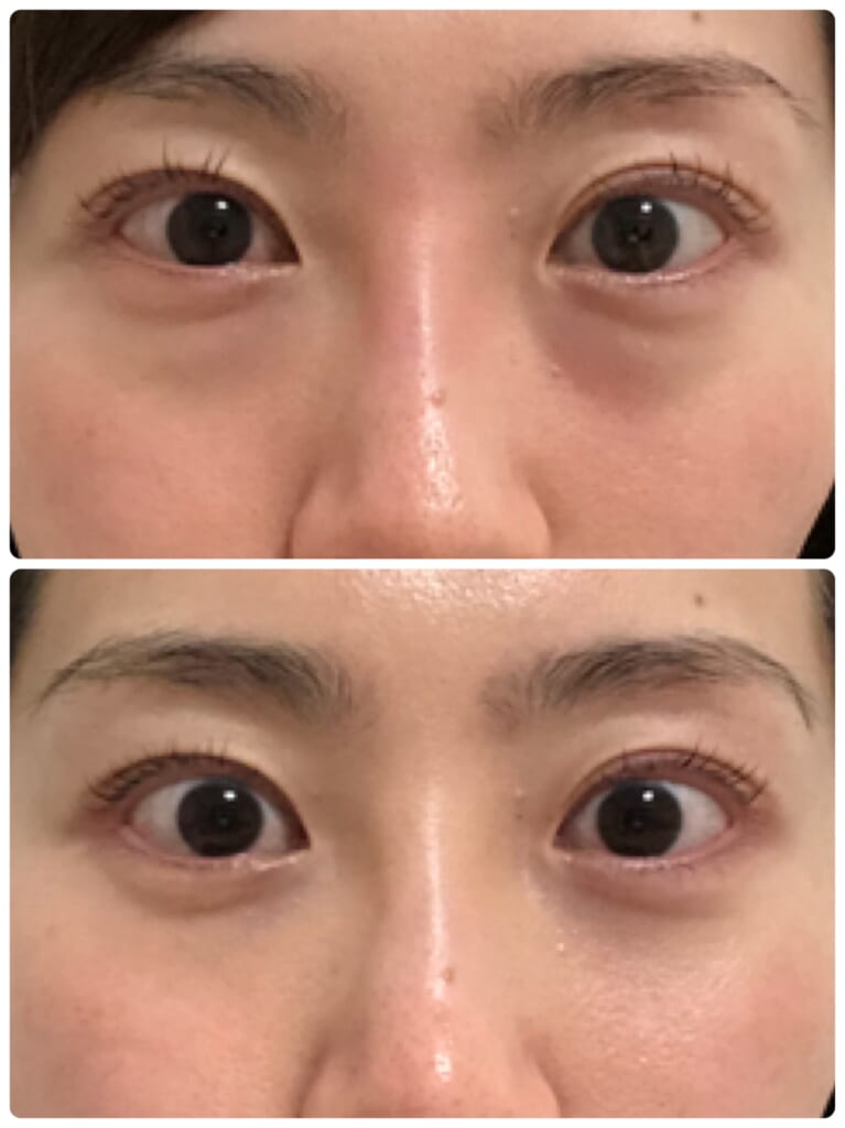 目の下のクマ撃退メニュー🧸