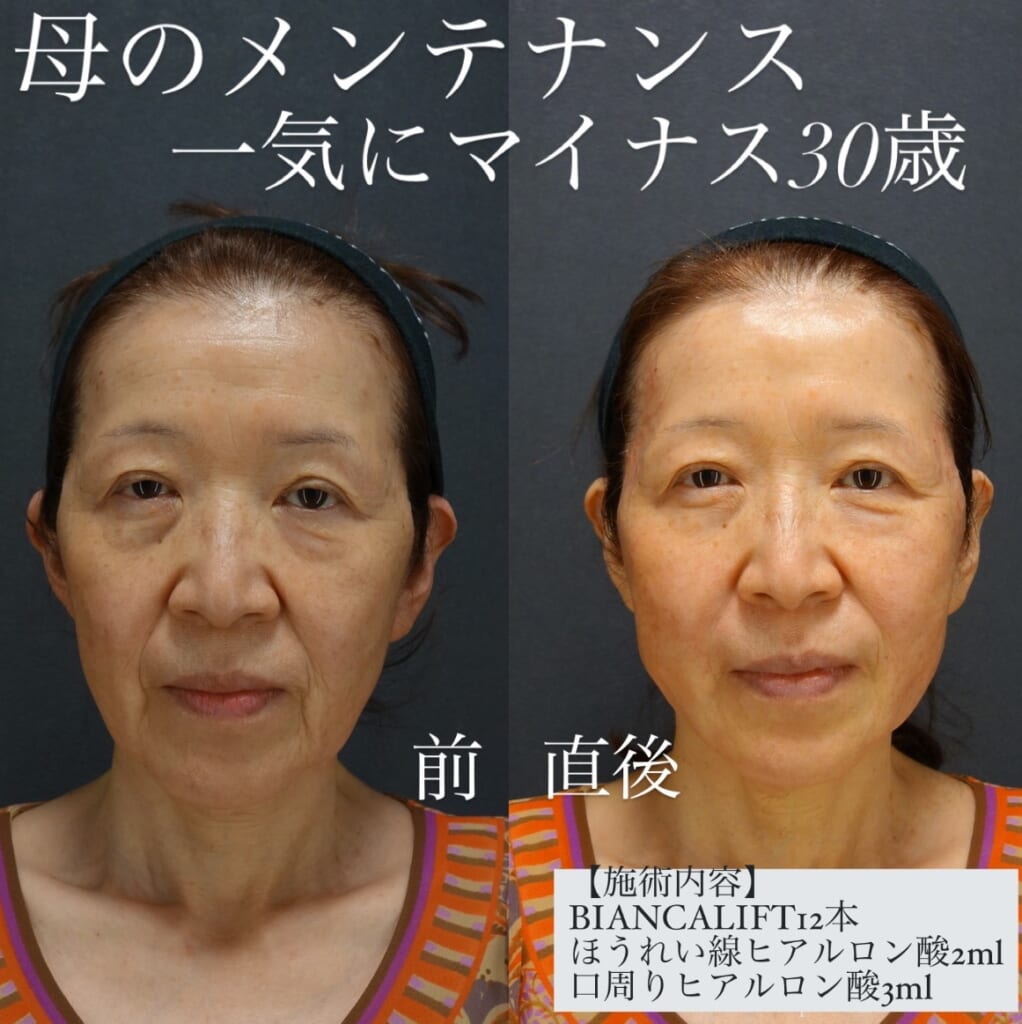 糸でリフトアップ💖ビアンカリフト症例✨