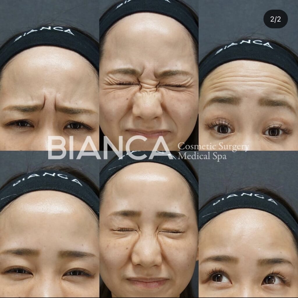 シワ撃退💉ボトックス治療