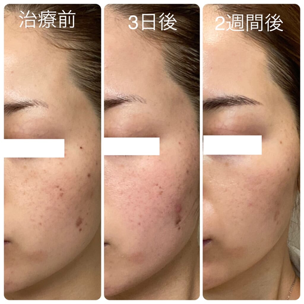 BIANCAの定番✨シミ治療👆ピコスポット経過