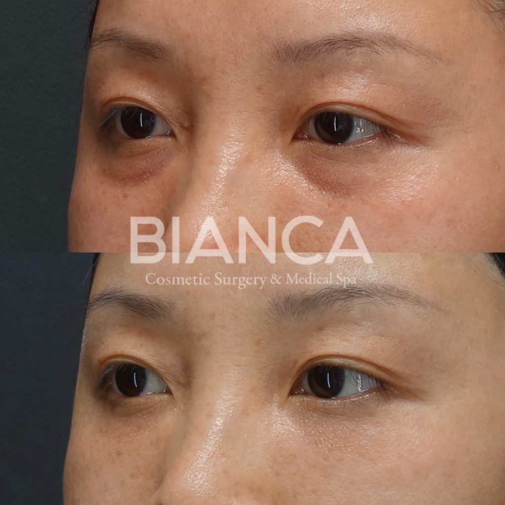 目の下クマ・たるみ取り（経結膜脱脂術）とコンデンスリッチフェイス（CRF）目の下によるクマ治療、症例写真・ビフォーアフター クマ取り（経結膜脱脂術）の経過は？腫れ・内出血・仕上がりを医師が解説【ビアンカクリニック】