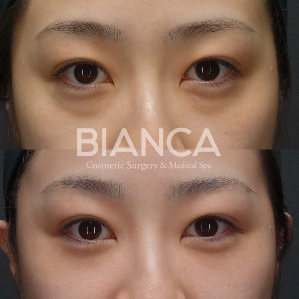 目の下クマ・たるみ取り（経結膜脱脂術）とコンデンスリッチフェイス（CRF）目の下によるクマ治療、症例写真・ビフォーアフター