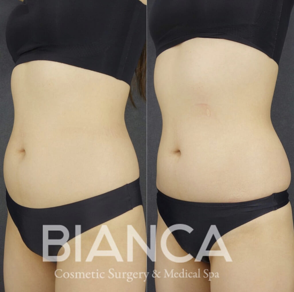 エムスカルプトでボディメイク🏋️‍♀️