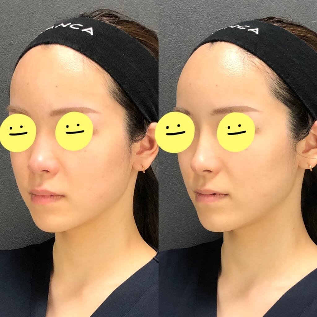 👃ヒアルロン酸注入👃