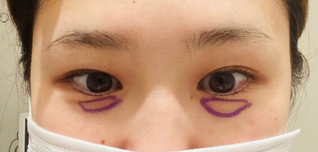 私の目の下クマ・たるみ取り体験談🐻💖