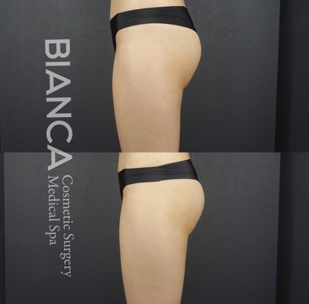 エムスカルプトでボディメイク