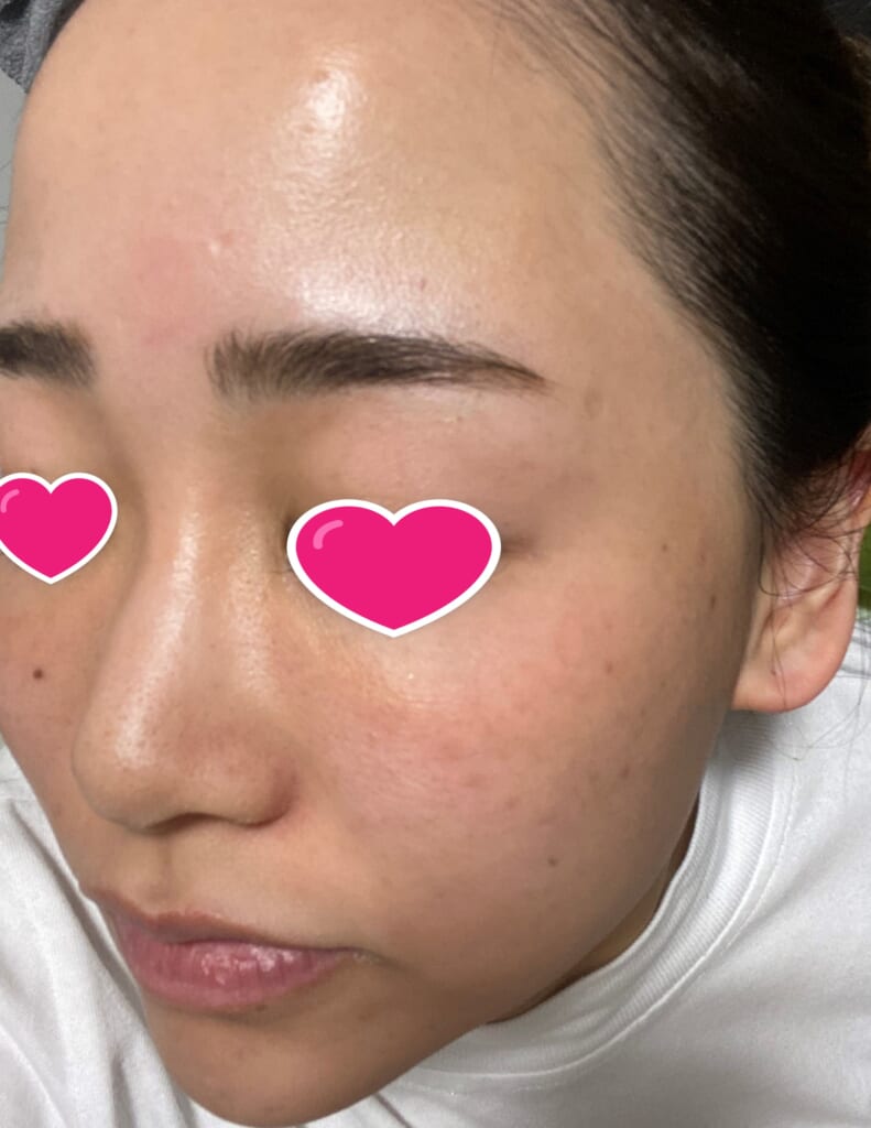 セラピューティック👀治療経過~1週目~