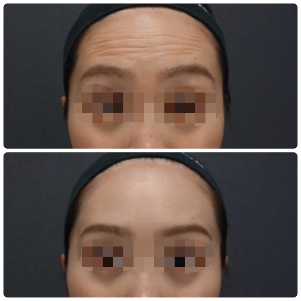 注入治療体験談💉～ボトックス編～