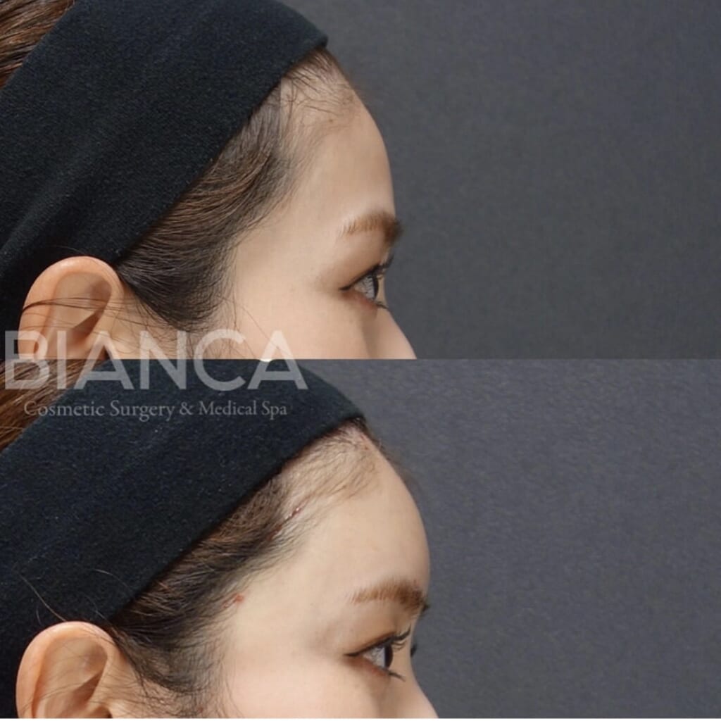 額ヒアルロン酸注入💉💕