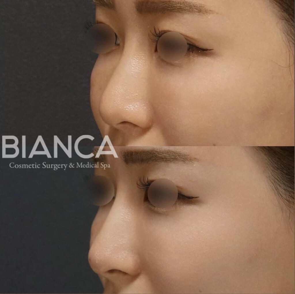 鼻先ヒアルロン酸💉👃体験