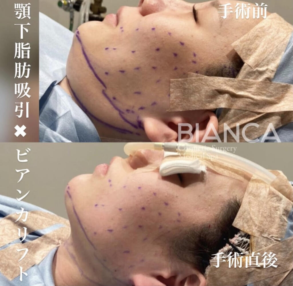 脂肪吸引＋糸リフト🎈