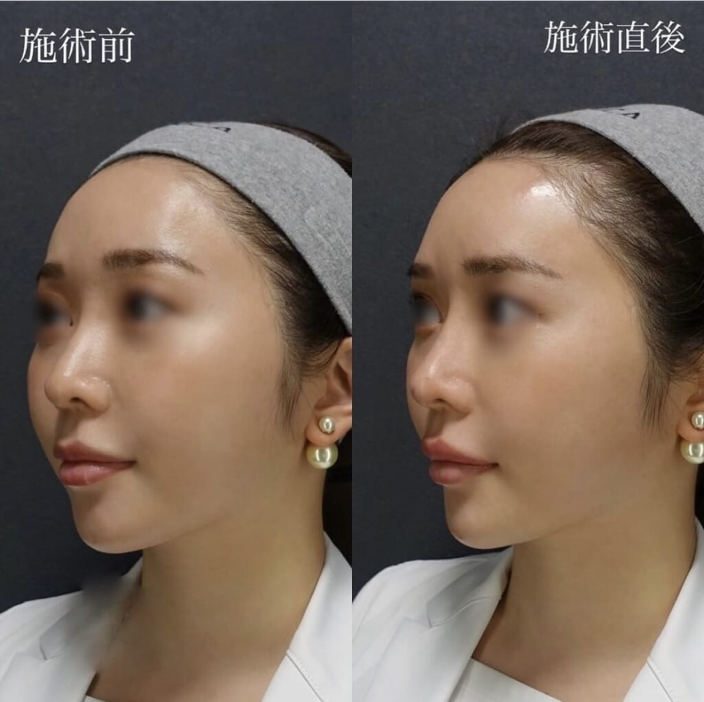 ヒアルロン酸before💗after