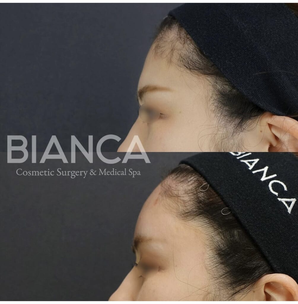 🧡おでこのヒアルロン酸注入🧡