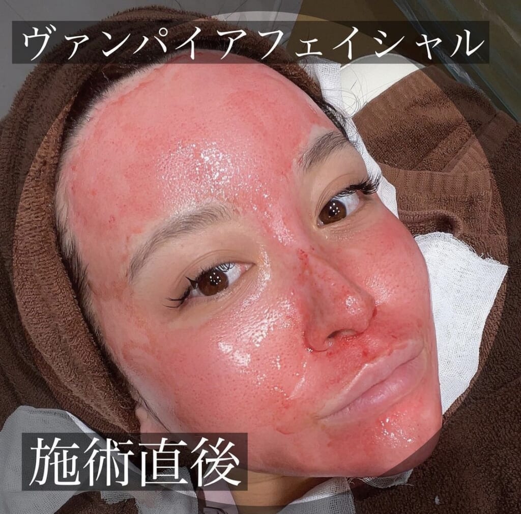 気になる毛穴に✨ヴァンパイアフェイシャル