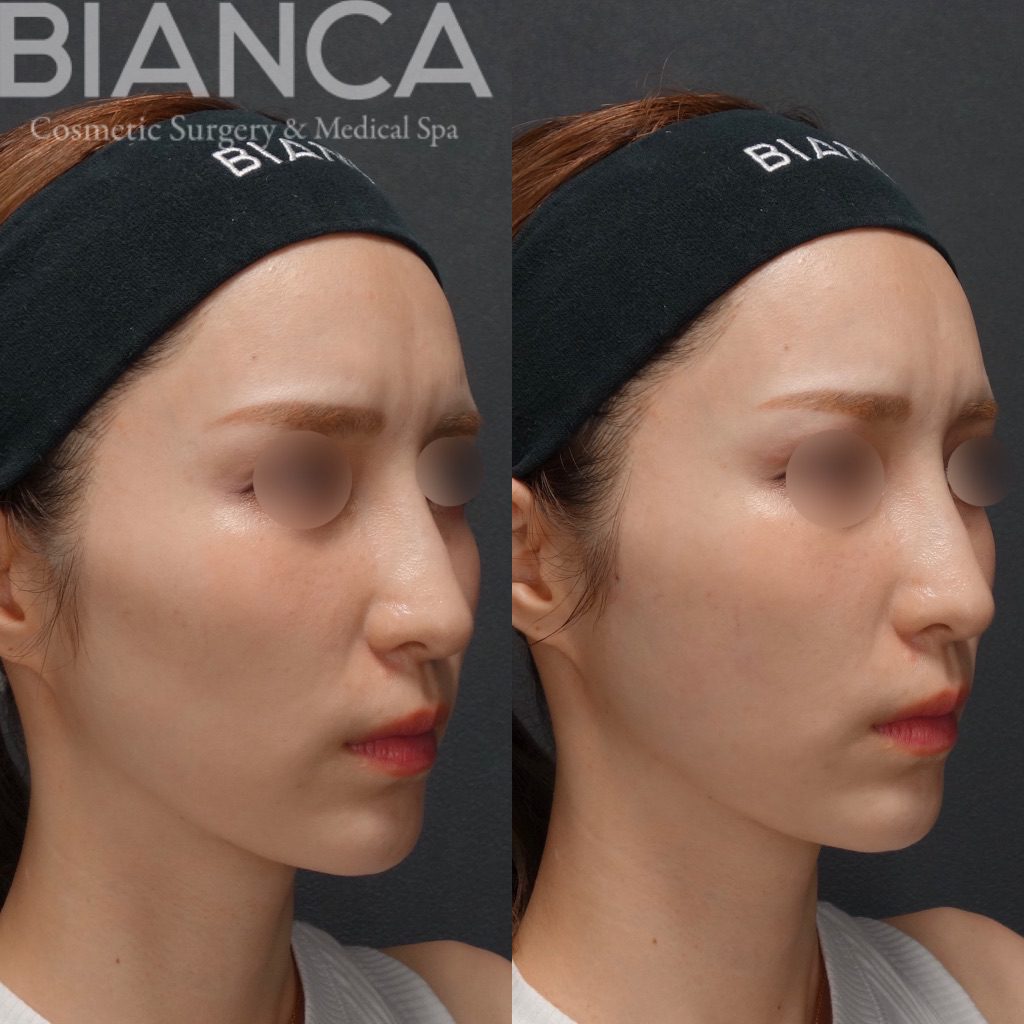 ヒアルロン酸注入