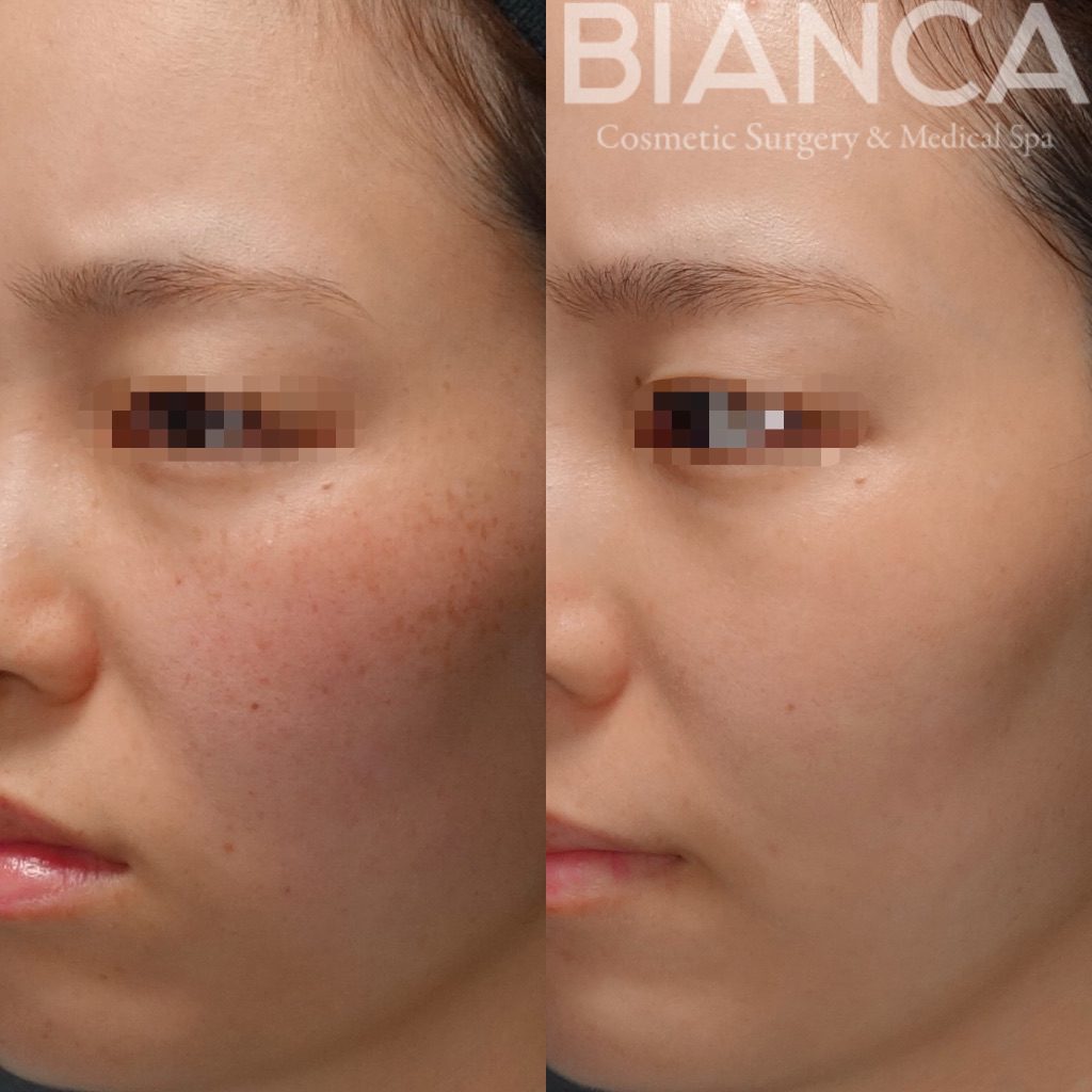 ピコフォーカス（ピコフラクショナル）