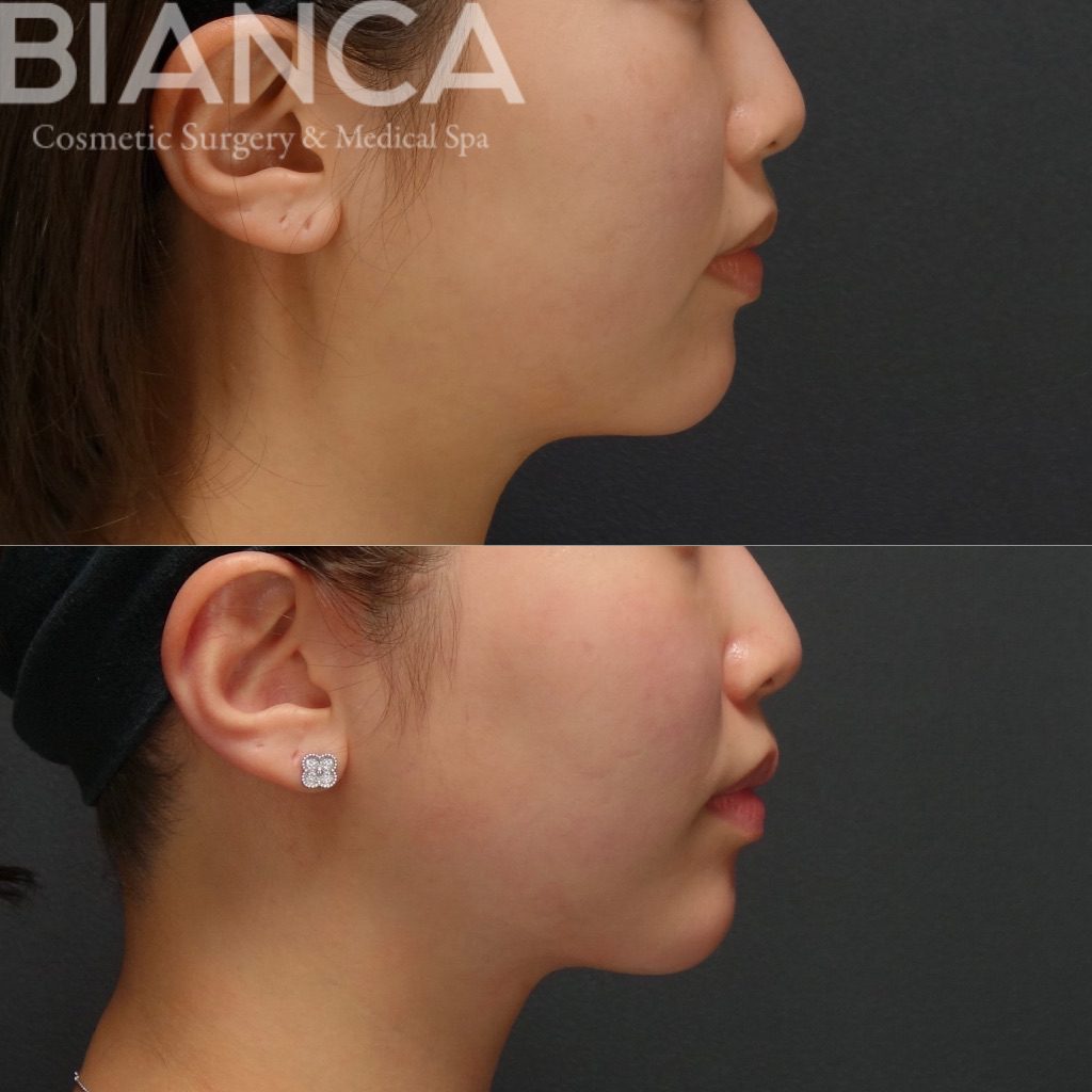 フェイスライン脂肪吸引