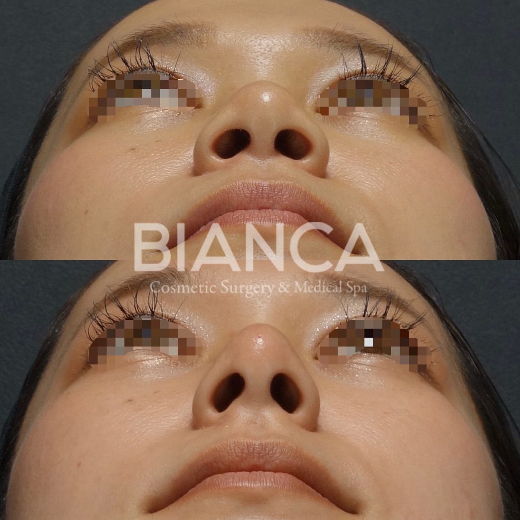 ヒアルロン酸注入