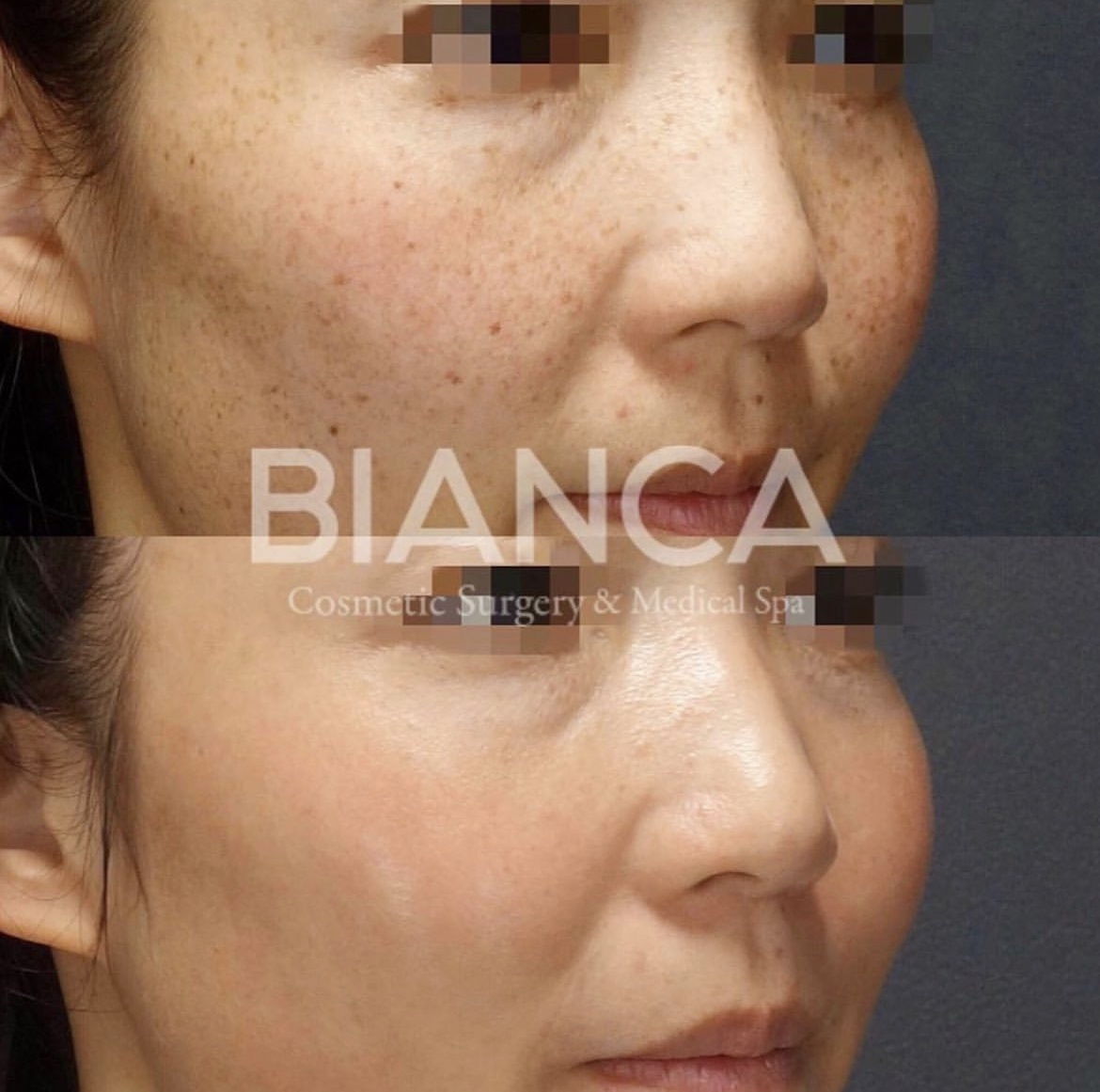 ピコスポット＋ピコトーニング