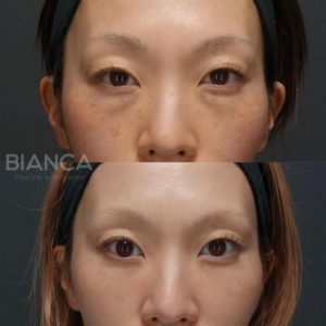 目の下クマ・たるみ取り＋CRF（目の下・ゴルゴ）セットの症例写真