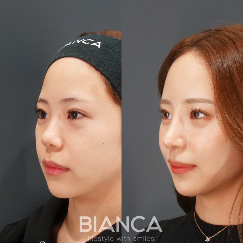 鼻中隔延長・鼻尖形成・オーダープロテーゼ・額こめかみCRF脂肪注入