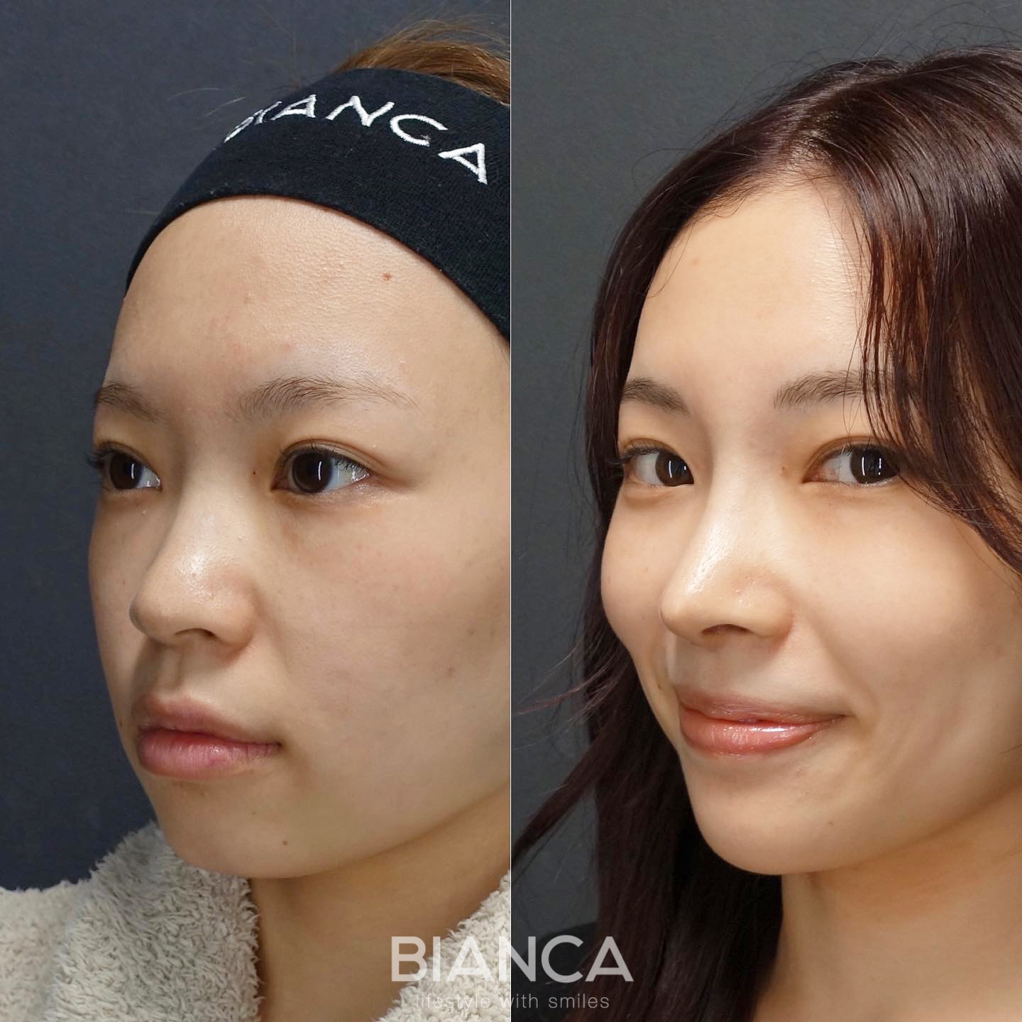 鼻中隔延長・鼻尖形成・オーダープロテーゼ・鼻骨骨切り幅寄せ