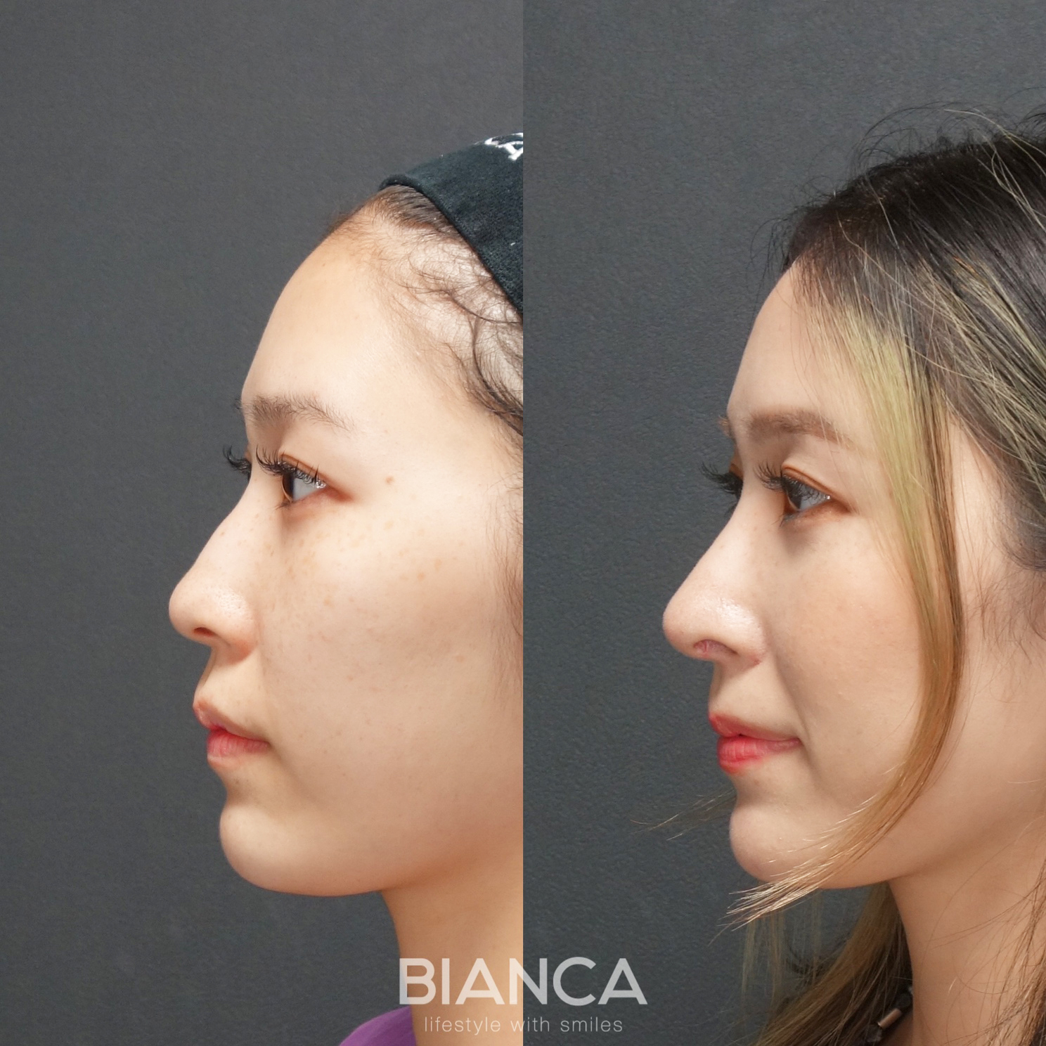 鼻中隔延長・鼻尖形成鼻骨・骨切り幅寄せ