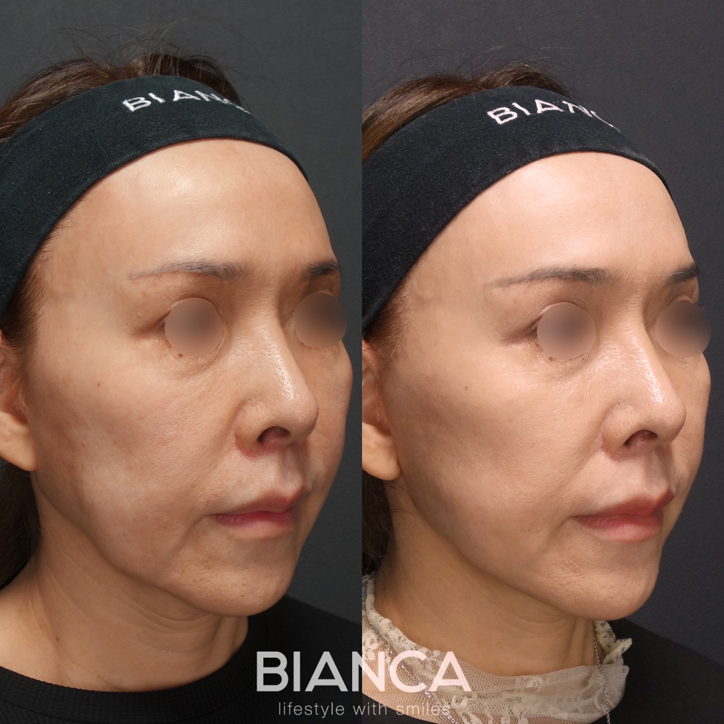 トータルフェイスリフト