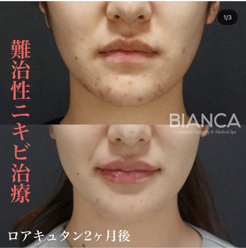 💊アンチニキビメソッド💊