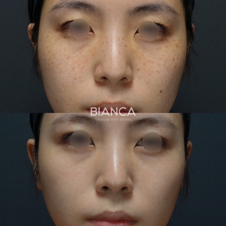 ピコスポット1回 ピコトーニング20回